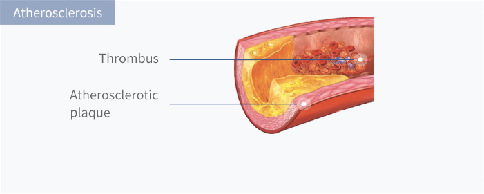 Atherosclerosis